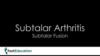 FootEd Subtalar Arthritis Subtalar Fusion [upl. by Ellesij218]