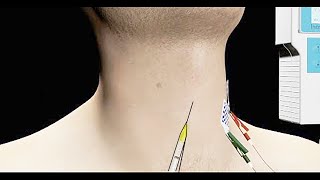 Spasmodic Dysphonia Treated with EMG Guided Botox Injection [upl. by Eytak]