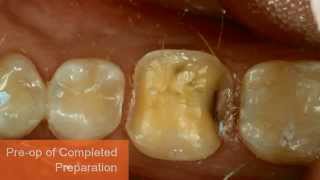 Immediate Dentin Sealing Technique [upl. by Penman209]