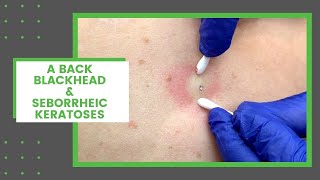 A Back Blackhead amp Seborrheic Keratoses  Dr Derm [upl. by Siuraj]