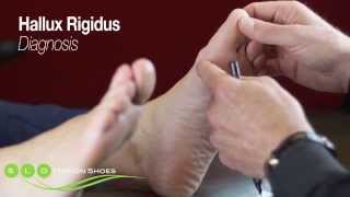 Hallux Rigidus Causes Diagnosis and Treatment [upl. by Nylrehc]