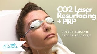 CO2 Laser Skin Resurfacing  PRP  Better Results and Faster Recovery [upl. by Annaig303]