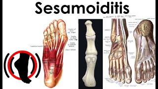 Sesamoiditis  Treatment Complications [upl. by Irb]